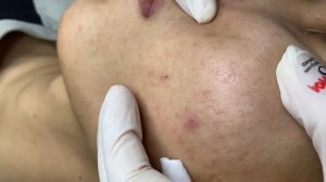 Acne collection • A019 • Архив SacDepSpa • АСМР