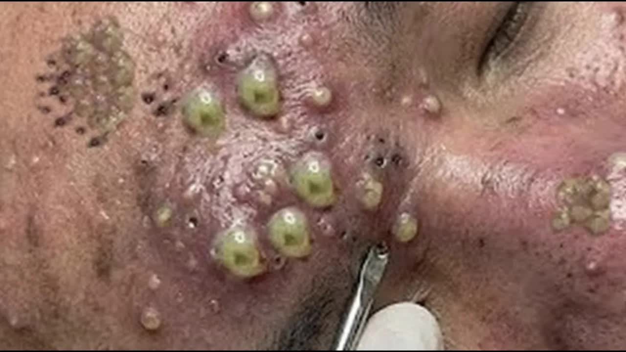 Очищение и омоложение кожи лица смотреть онлайн