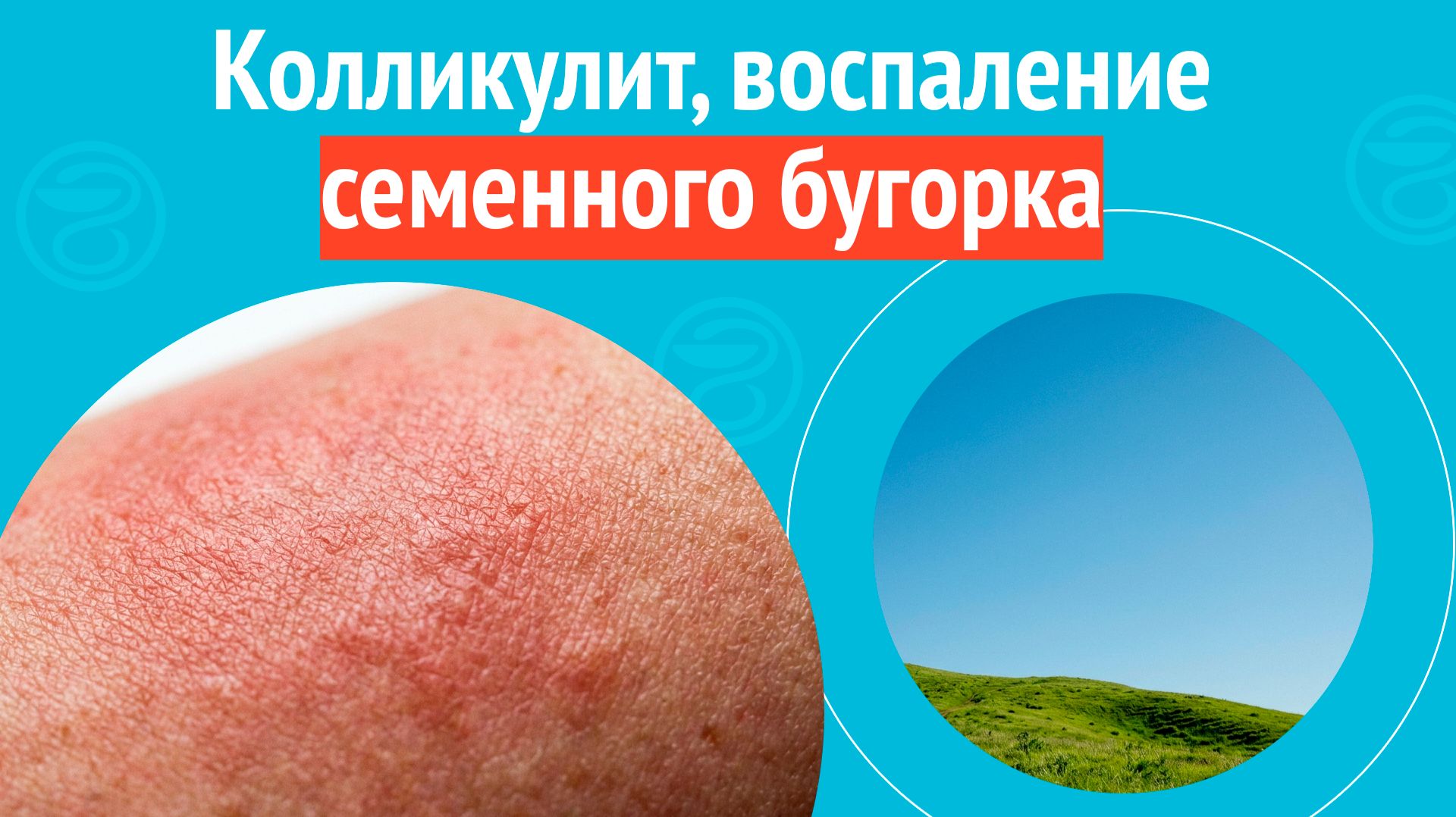 😨 Колликулит, воспаление семенного бугорка. Клинический случай №1666 смотреть онлайн