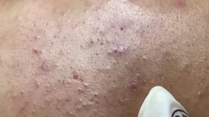 Удаление кожных образований на лице