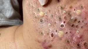 Экстремальное удаление чёрных точек. Удовольствие и релакс.