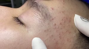 Удаление прыщей и комедонов — полный процесс