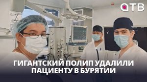 Гигантский полип удалили пациенту в Бурятии