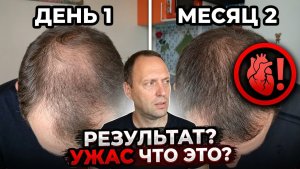 Влог: Миноксидил и Финастерид дали побочку через 2 месяца - Лечение алопеции