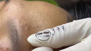 Чистка лица — удаление прыщей и черных точек