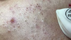 Удаление воспаленных прыщей на лице