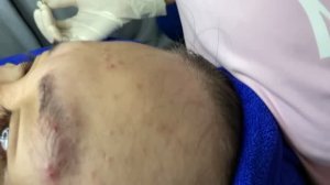 Процесс чистки лица в спа-салоне - удаление акне