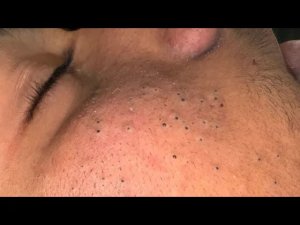 Уход за кожей | Глубокое очищение пор от прыщей и чёрных точек
