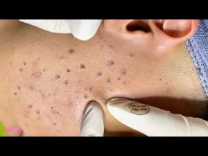 Глубокие чёрные точки и скрытые прыщи | Удаление кератиновых пробок – Спа Линь Мун