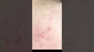 Выдавливание прыщей на спине