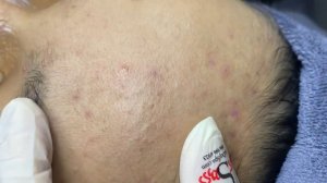 325 • Acne collection • АСМР • Relax Spa