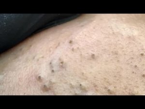 30 лучших средств и процедур для удаления черных точек!