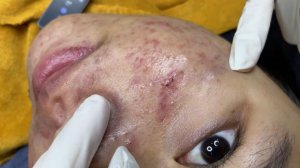 331 • Acne collection • АСМР • Relax Spa