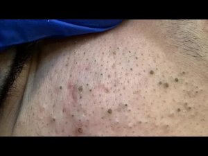 Глубокое очищение лба от акне и черных точек