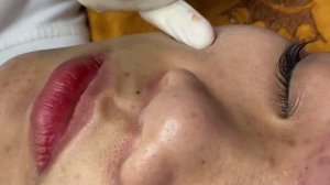 Чистка лица — удаление закупорок пор и воспалений
