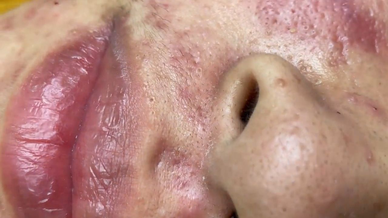 332 • Acne Collection • АСМР • Relax Spa