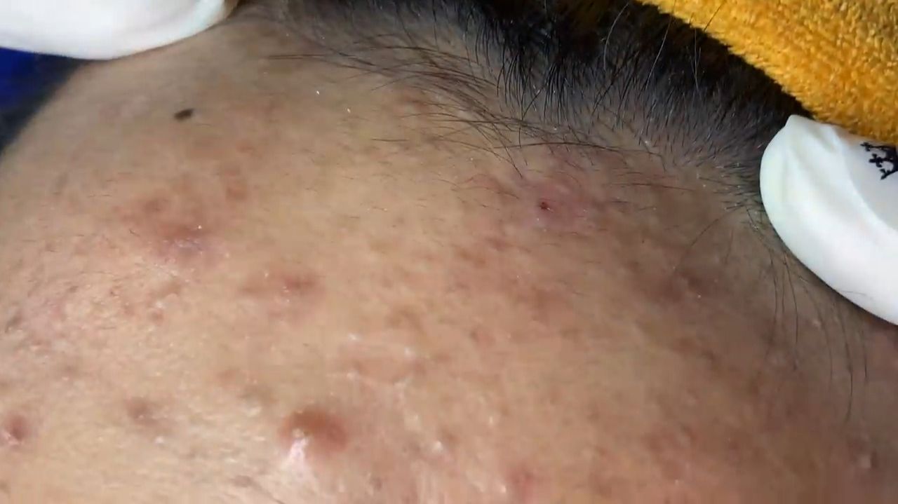 Acne Collection • A021 • Архив SacDepSpa • АСМР