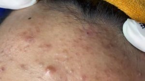 Acne collection • A021 • Архив SacDepSpa • АСМР