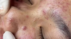 309 • Acne collection • АСМР • Relax Spa