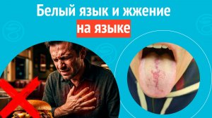 👅 Белый язык и жжение на языке. Клинический случай №1657