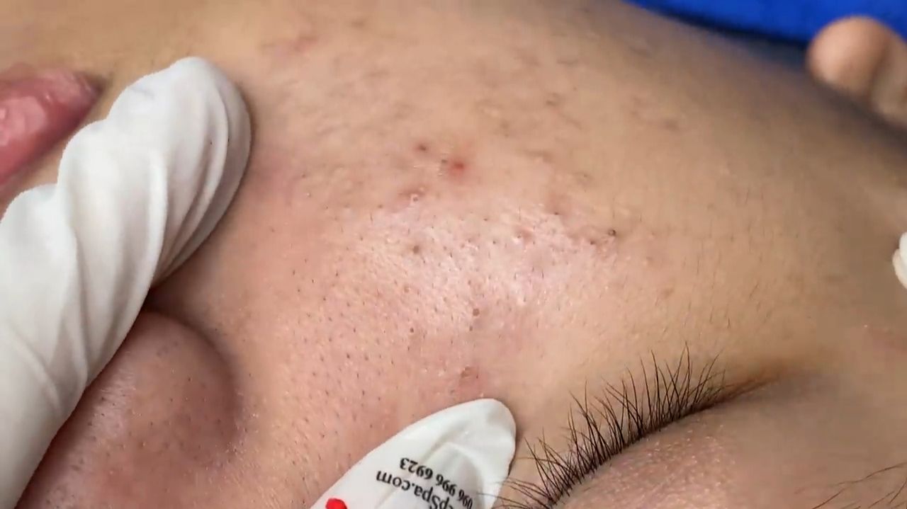 333 • Acne Collection • АСМР • Relax Spa