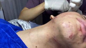 326 • Acne collection • АСМР • Relax Spa