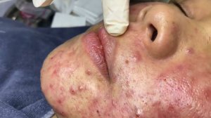 308 • Acne collection • АСМР • Relax Spa