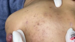 Acne collection • A020 • Архив SacDepSpa • АСМР