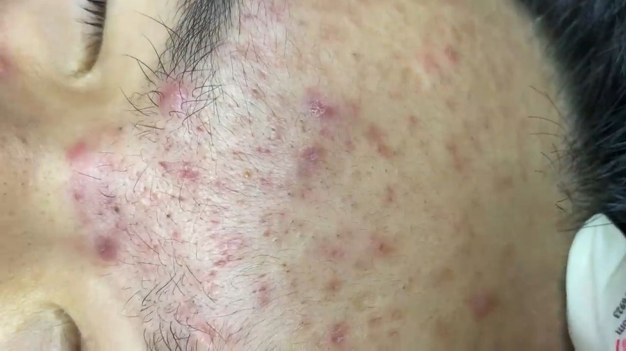 337 • Acne Collection • АСМР • Relax Spa