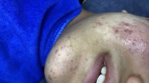 Acne collection • A024 • Архив SacDepSpa • АСМР