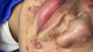 338 • Acne collection • АСМР • Relax Spa