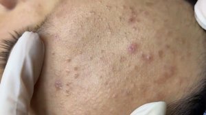 340 • Acne collection • АСМР • Relax Spa
