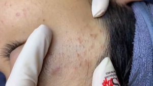 339 • Acne collection • АСМР • Relax Spa