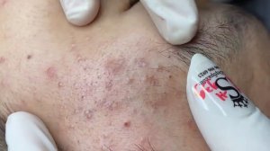 Acne collection • A023 • Архив SacDepSpa • АСМР