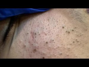 Лучшая корейская рутина ухода для удаления прыщей и черных точек