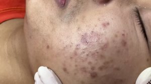 Удаление сальных пробок и воспалений на лице