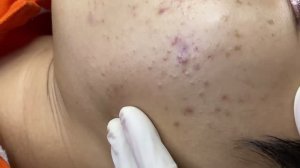 Чистка лица от засорений в порах и воспалений