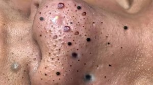 Экстремальное удаление черных точек. Удовольствие и релакс
