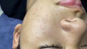 342 • Acne collection • АСМР • Relax Spa