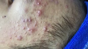 Глубокая чистка кожи лица от прыщей и черных точек