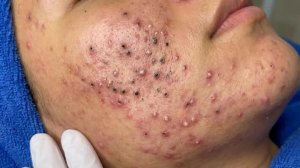 Удаление черных точек в Sac Dep Spa @499