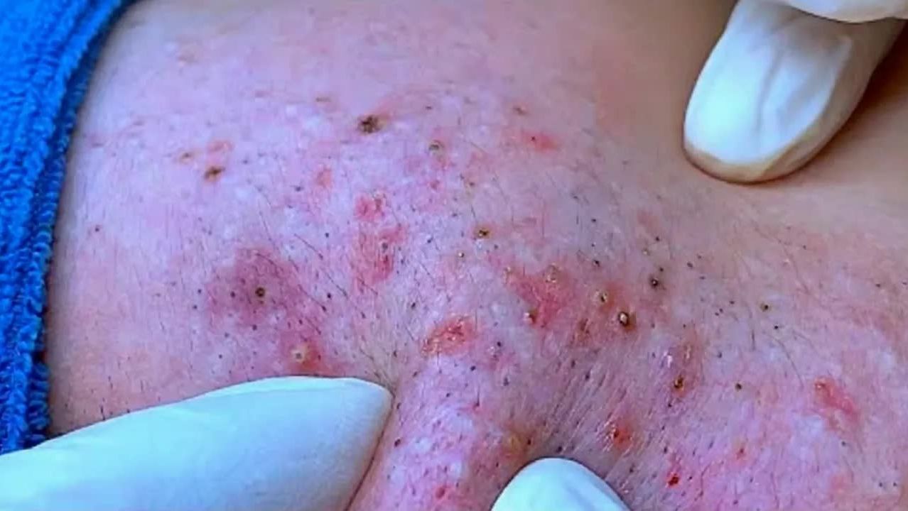 Удаление черных точек в Sac Dep Spa смотреть онлайн