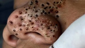Экстремальное удаление черных точек 💆♀️ Расслабление