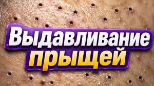 🔴 УДАЛЕНИЕ ПРЫЩЕЙ ОНЛАЙН | Чистка лица, чёрные точки, акне — LIVE-эфир