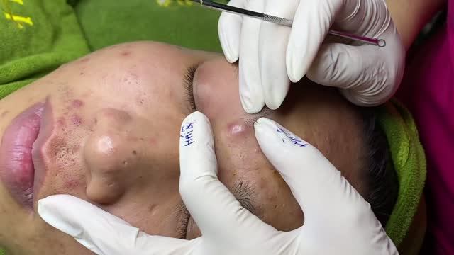 Удаление крупных прыщей и кист.