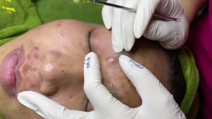 Удаление крупных прыщей и кист.