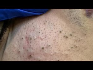 Глубочайшее очищение пор и корейский уход за кожей