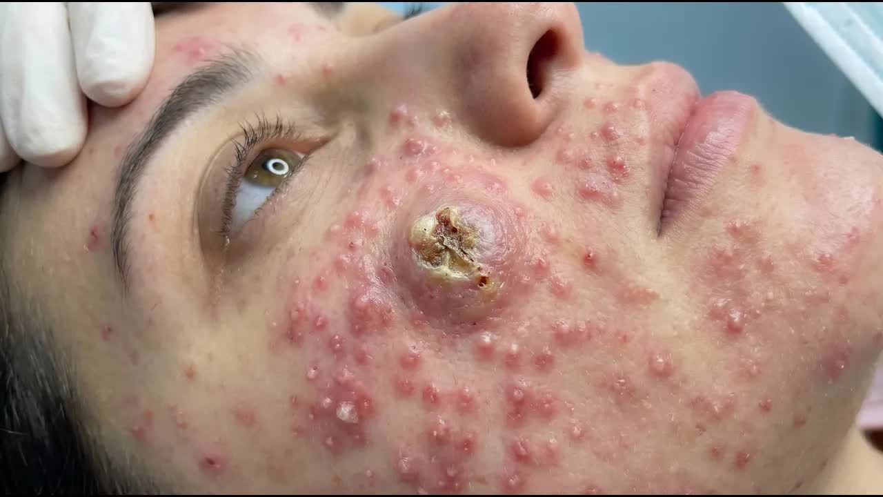 🌾 Очищение и омоложение кожи с помощью лица смотреть онлайн