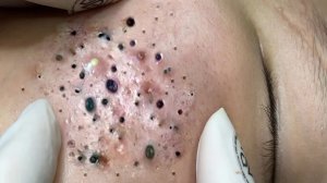 Экстремальное удаление черных точек: расслабляющее видео