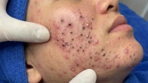 Извлечение черных точек в Sac Dep Spa